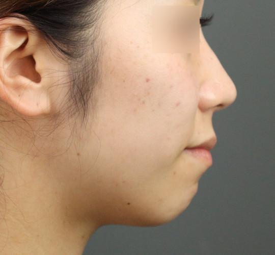 20代女性のテスリフトノーズ Before 症例写真