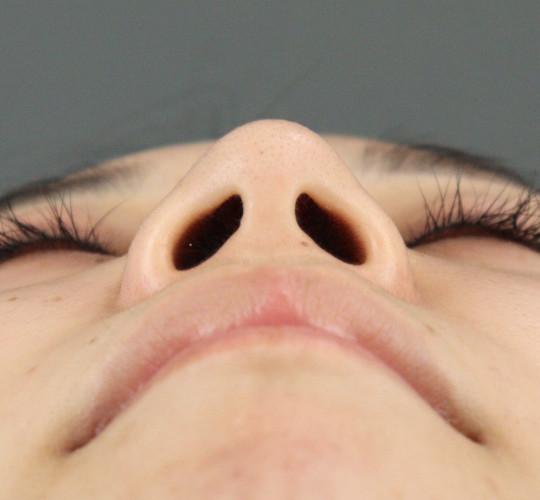 20代女性のテスリフトノーズ Before 症例写真