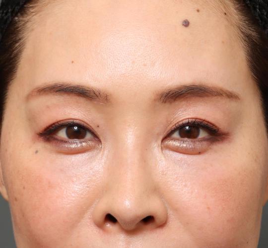 40代女性の眉下切開法 After 症例写真
