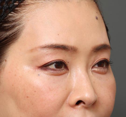 40代女性の眉下切開法 After 症例写真