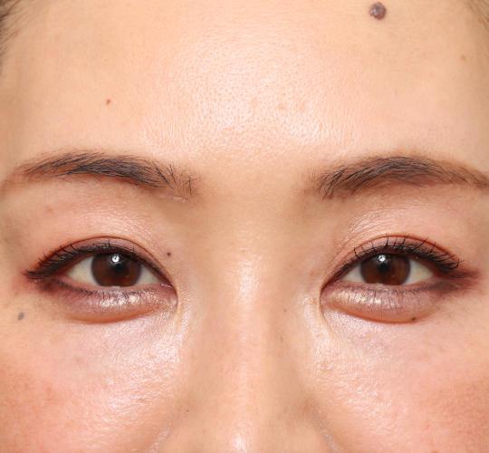 40代女性の眉下切開法 After 症例写真