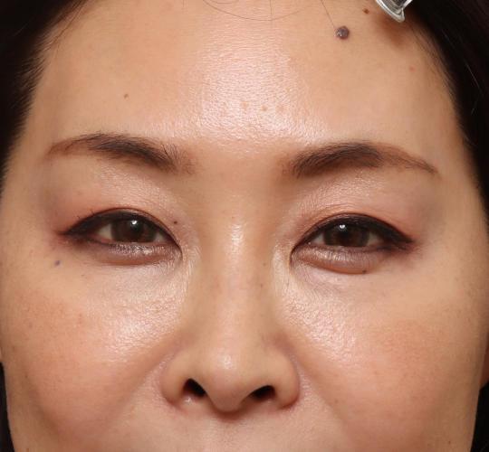 40代女性の眉下切開法 Before 症例写真