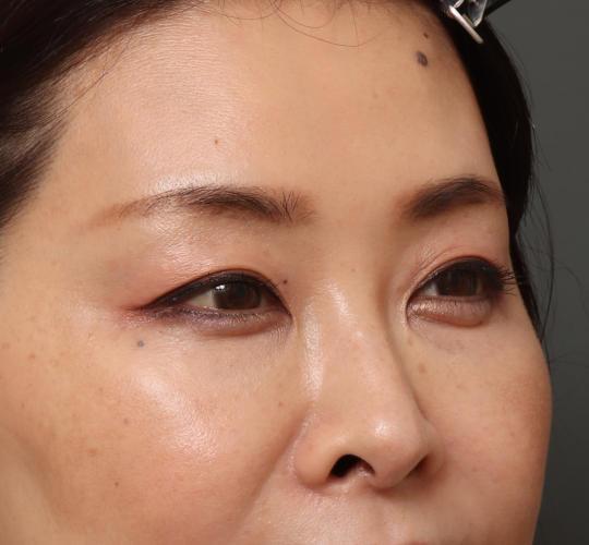 40代女性の眉下切開法 Before 症例写真