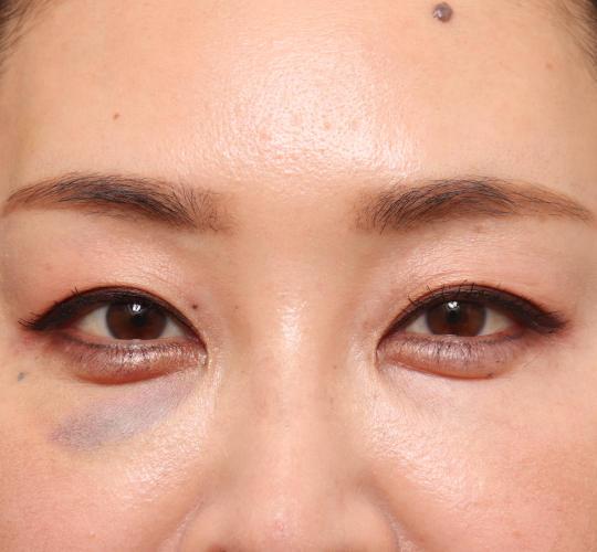 40代女性の眉下切開法 Before 症例写真
