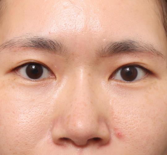 30代女性の眉下切開法 After 症例写真