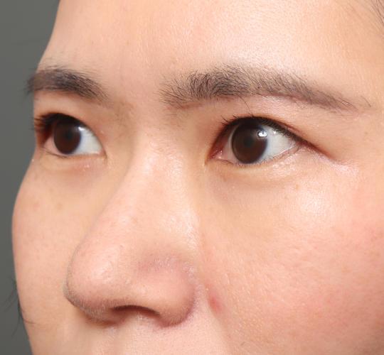 30代女性の眉下切開法 After 症例写真