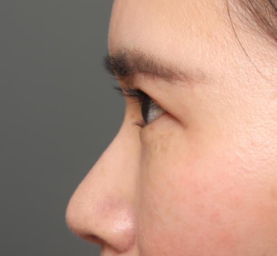 30代女性の眉下切開法 After 症例写真