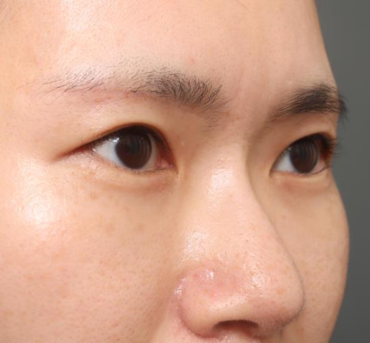 30代女性の眉下切開法 After 症例写真