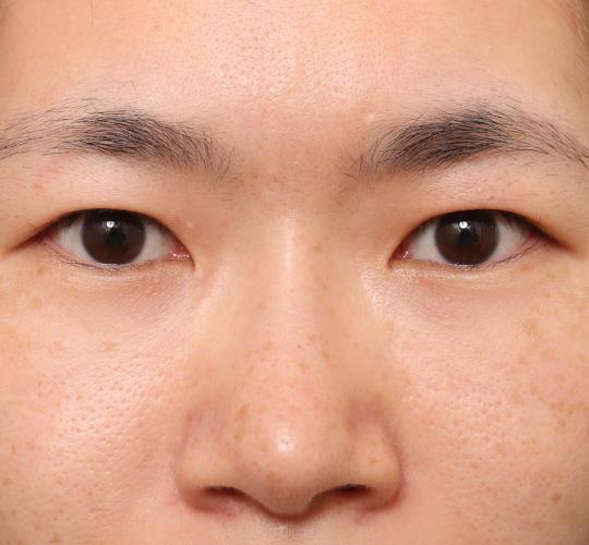 30代女性の眉下切開法 Before 症例写真