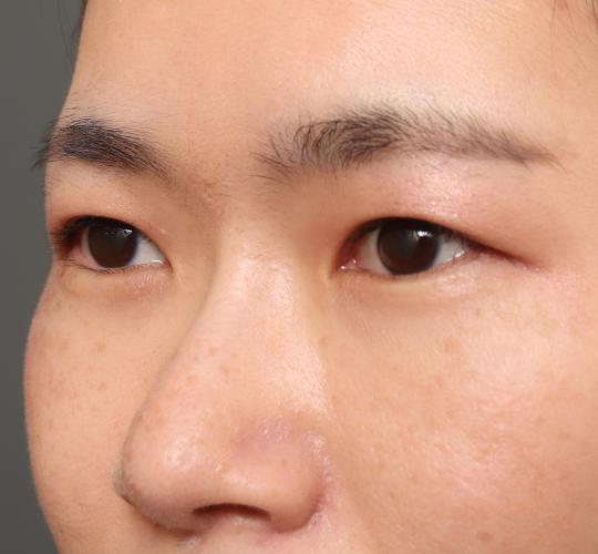 30代女性の眉下切開法 Before 症例写真