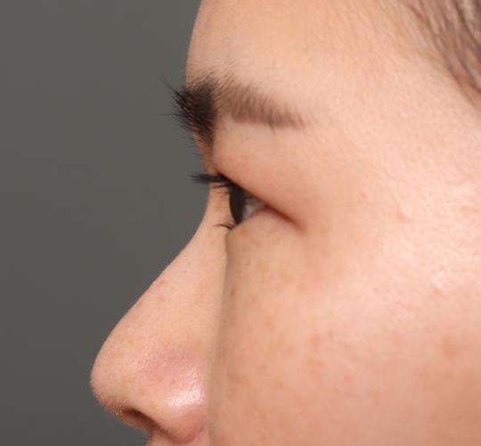 30代女性の眉下切開法 Before 症例写真