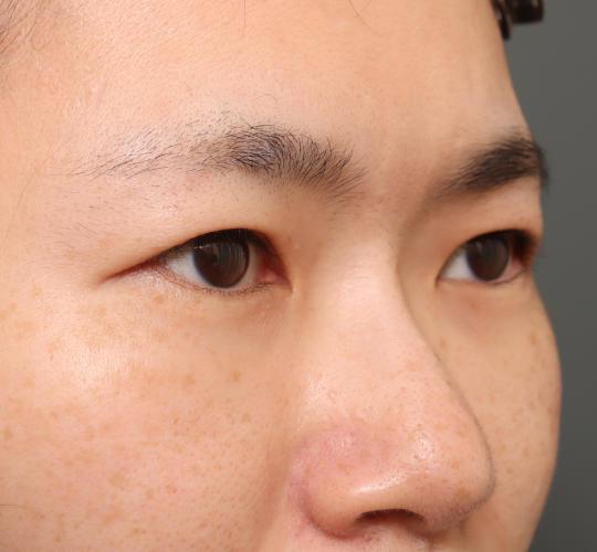 30代女性の眉下切開法 Before 症例写真