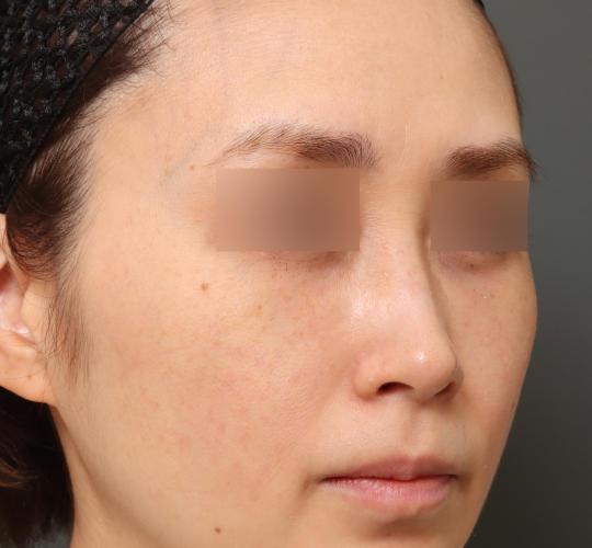 30代女性の3Dリポアイリフト  After 症例写真