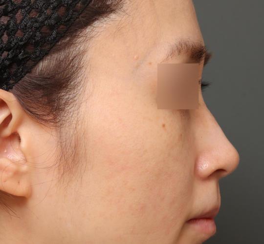 30代女性の3Dリポアイリフト  After 症例写真