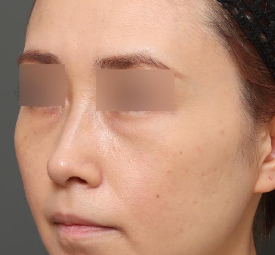 30代女性の3Dリポアイリフト  Before 症例写真