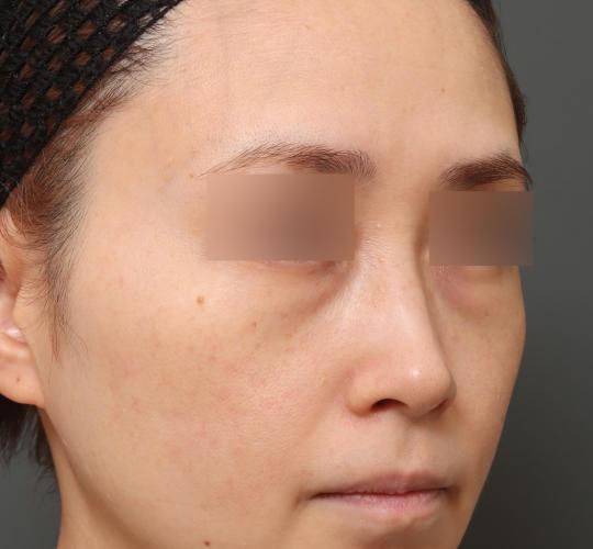 30代女性の3Dリポアイリフト  Before 症例写真