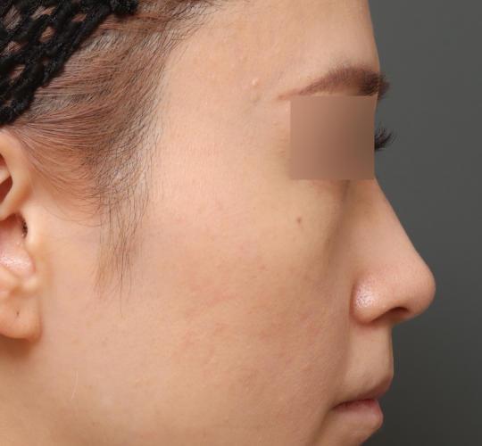 30代女性の3Dリポアイリフト  Before 症例写真