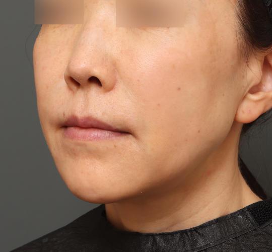 50代女性の耳介軟骨移植 After 症例写真