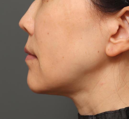 50代女性の耳介軟骨移植 After 症例写真