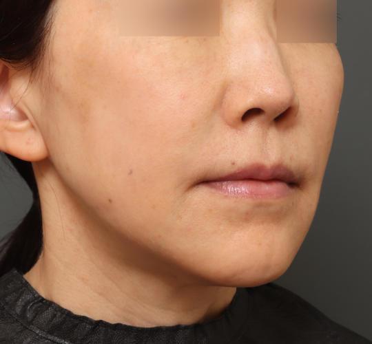 50代女性の耳介軟骨移植 After 症例写真