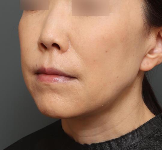 50代女性の耳介軟骨移植 Before 症例写真