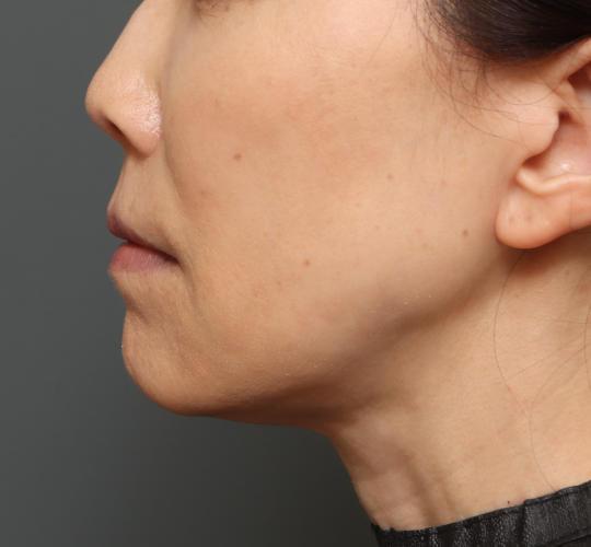 50代女性の耳介軟骨移植 Before 症例写真