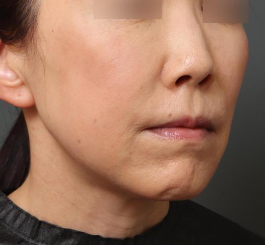 50代女性の耳介軟骨移植 Before 症例写真