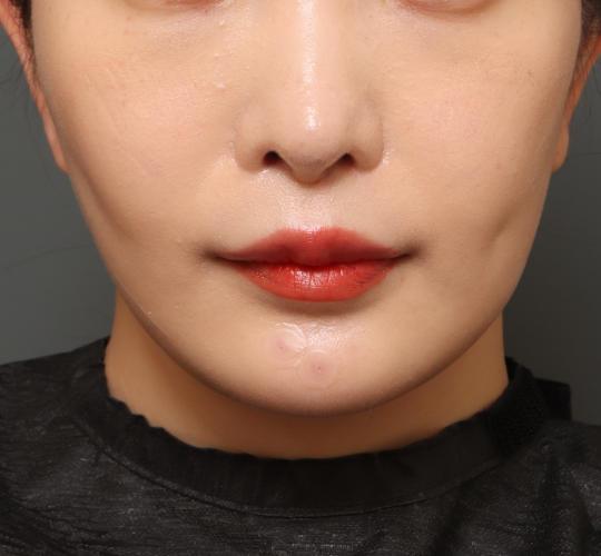 20代女性の人中短縮(リップリフト) After 症例写真