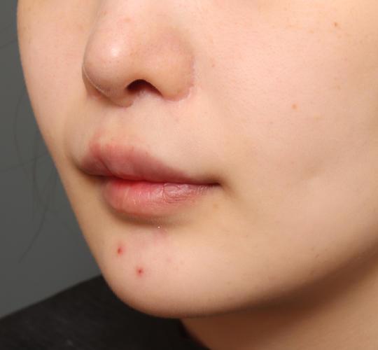20代女性の人中短縮(リップリフト) After 症例写真