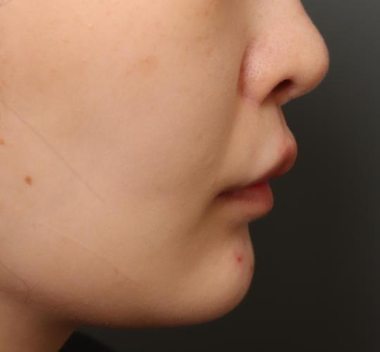 20代女性の人中短縮(リップリフト) After 症例写真