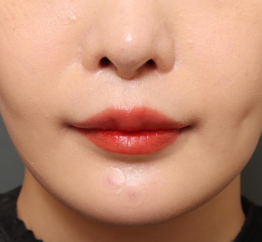 20代女性の人中短縮(リップリフト) After 症例写真