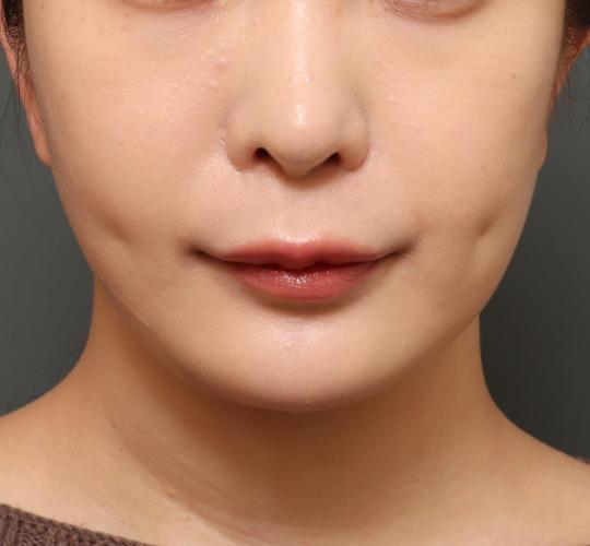 20代女性の人中短縮(リップリフト) Before 症例写真