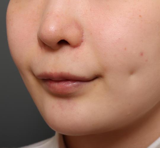 20代女性の人中短縮(リップリフト) Before 症例写真