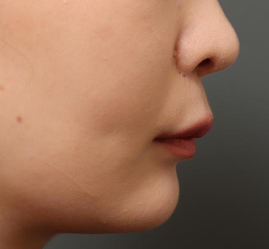 20代女性の人中短縮(リップリフト) Before 症例写真