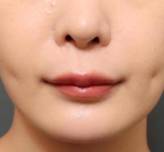 20代女性の人中短縮(リップリフト) Before 症例写真