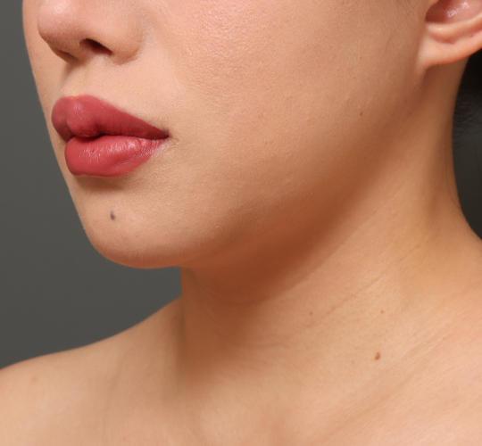 20代女性の二重アゴ筋肉縛り（ペリカン手術） After 症例写真