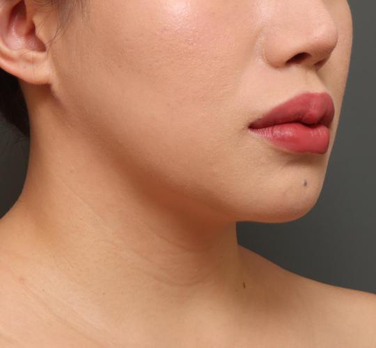 20代女性の二重アゴ筋肉縛り（ペリカン手術） After 症例写真