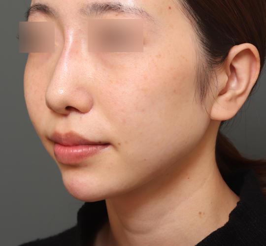 20代女性の人中短縮（リップリフト） After 症例写真