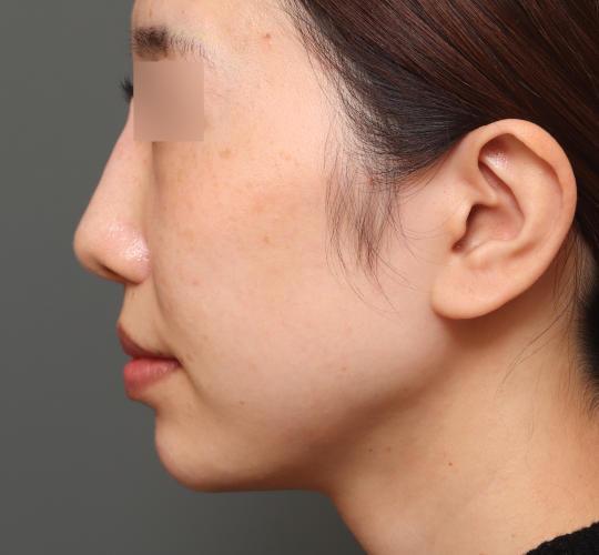 20代女性の人中短縮（リップリフト） After 症例写真