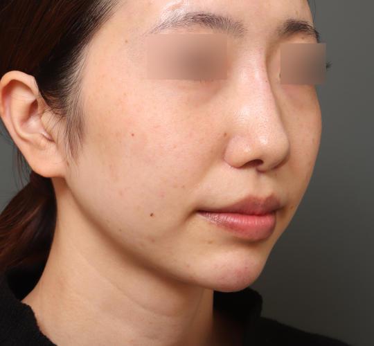 20代女性の人中短縮（リップリフト） After 症例写真