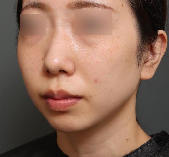 20代女性の人中短縮（リップリフト） Before 症例写真