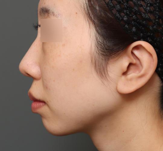 20代女性の人中短縮（リップリフト） Before 症例写真