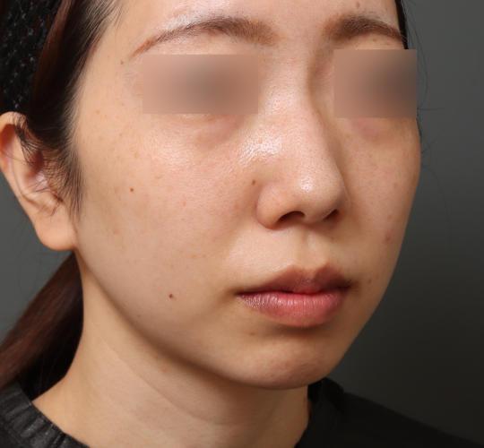20代女性の人中短縮（リップリフト） Before 症例写真