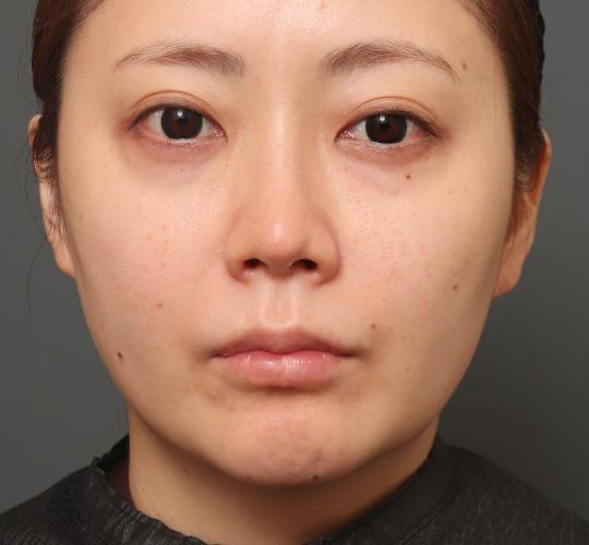 30代女性の鼻翼縮小（小鼻縮小） Before 症例写真
