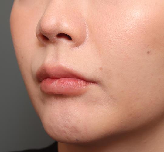 30代女性の人中短縮（リップリフト） Before 症例写真