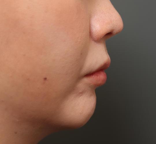 30代女性の人中短縮（リップリフト） Before 症例写真