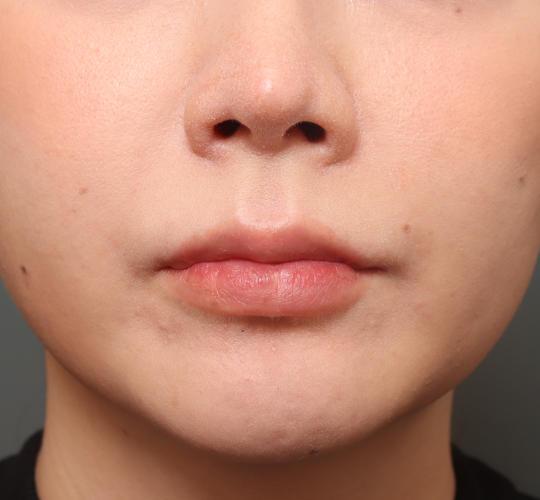 30代女性の人中短縮（リップリフト） Before 症例写真
