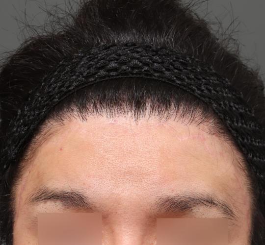 30代男性のエラ・アゴ・小顔 After 症例写真