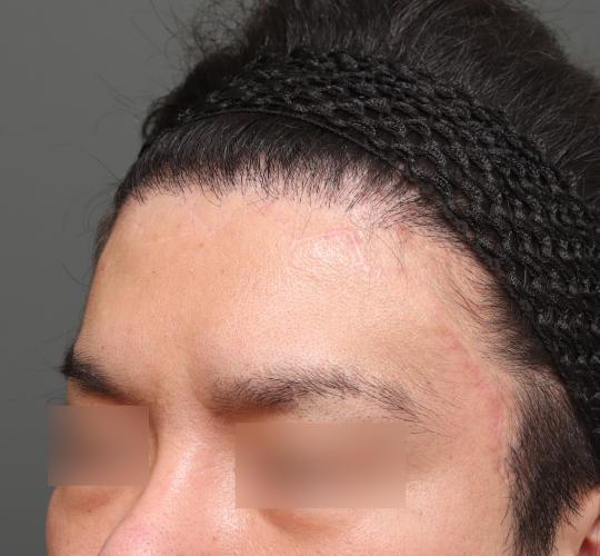 30代男性の生え際前進術 After 症例写真