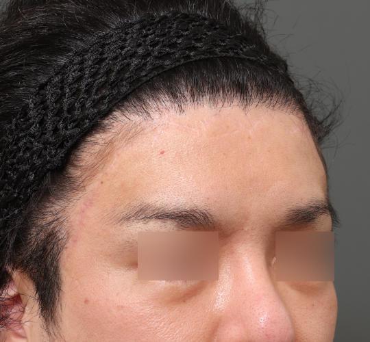 30代男性の生え際前進術 After 症例写真
